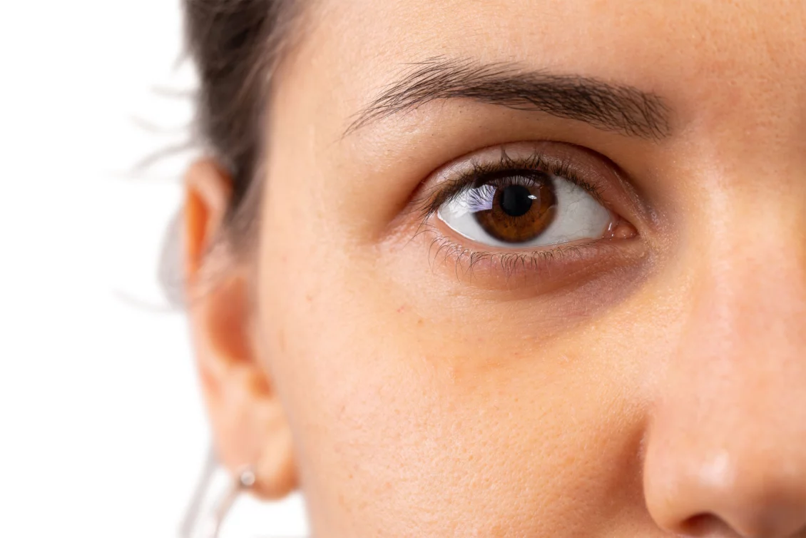 Augenringe entfernen Berlin