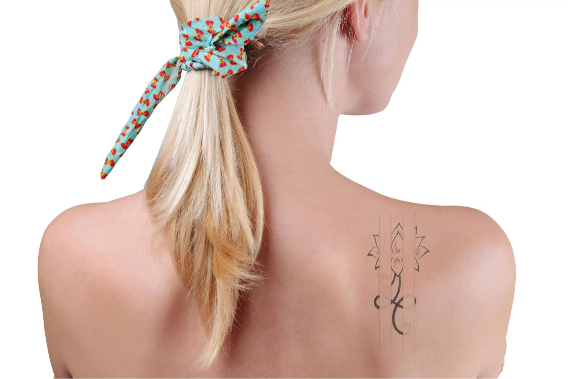 Cover-up lightening with Picosure in Berlin