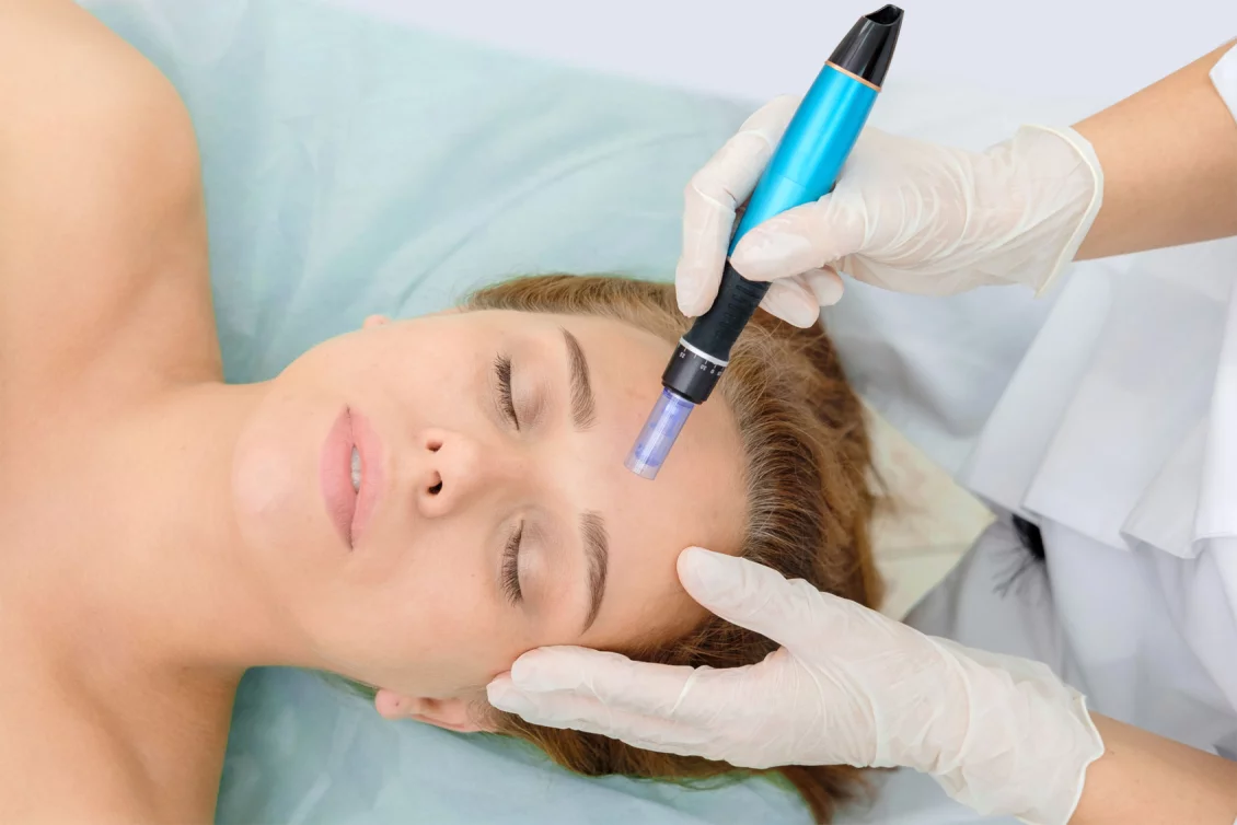 Microneedling Berlin