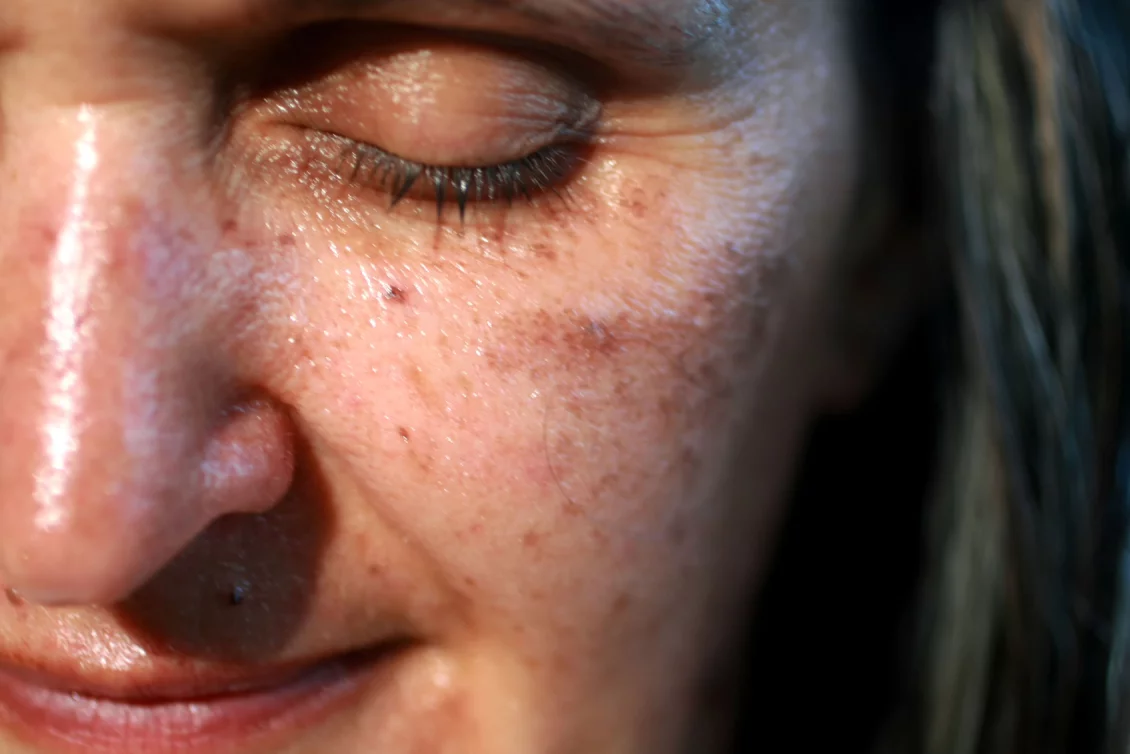 remove pigment spots Berlin