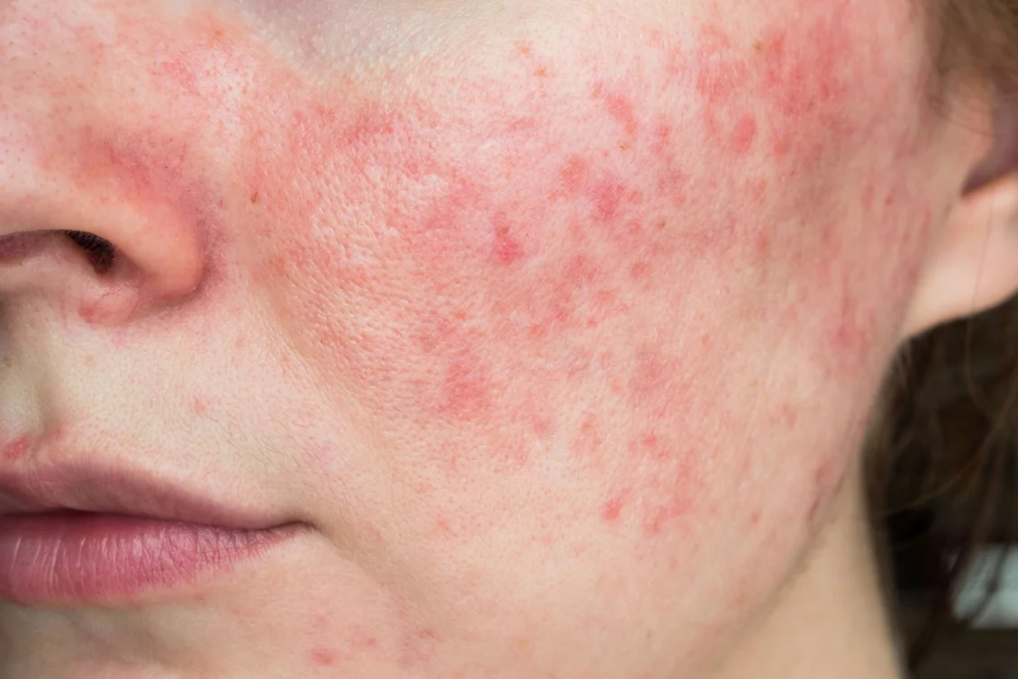 PRP therapy against acne scars Berlin