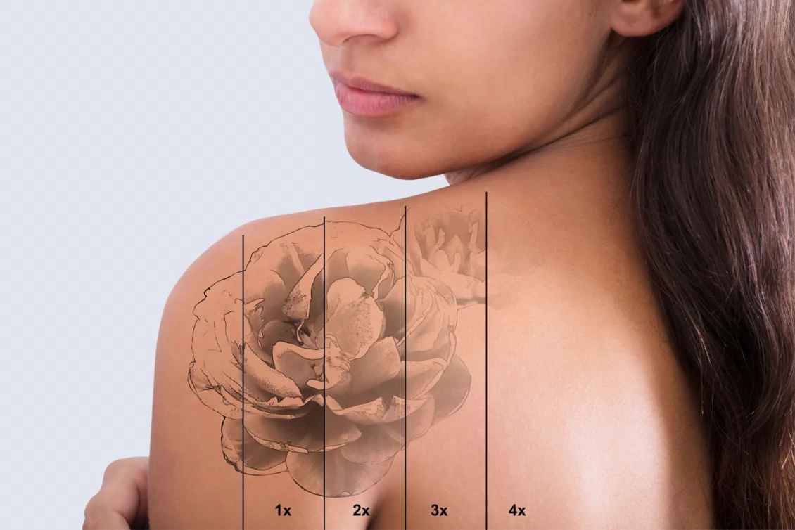 Tattoo removal Berlin