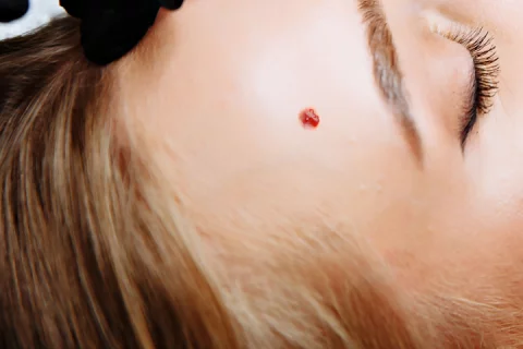 Removal of haemangioma Berlin