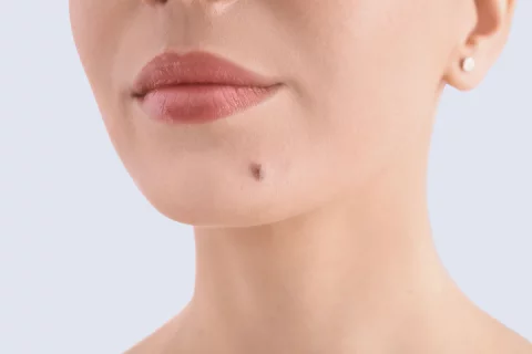birthmark removal Berlin