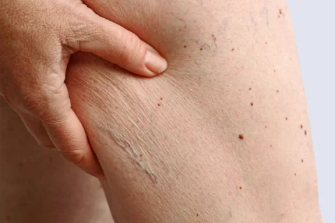 removing spider veins Berlin