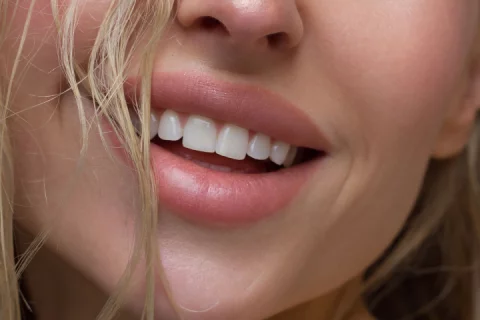 Lippen aufspritzen mit Hyaluron in Berlin Charlottenburg – Russian Lips