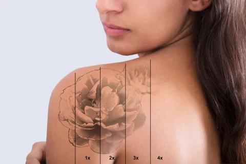 Tattoo removal Berlin