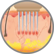 RF-Microneedling Berlin
