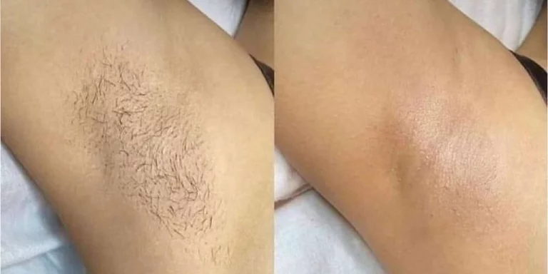 laser-hair-removal Berlin-before-after