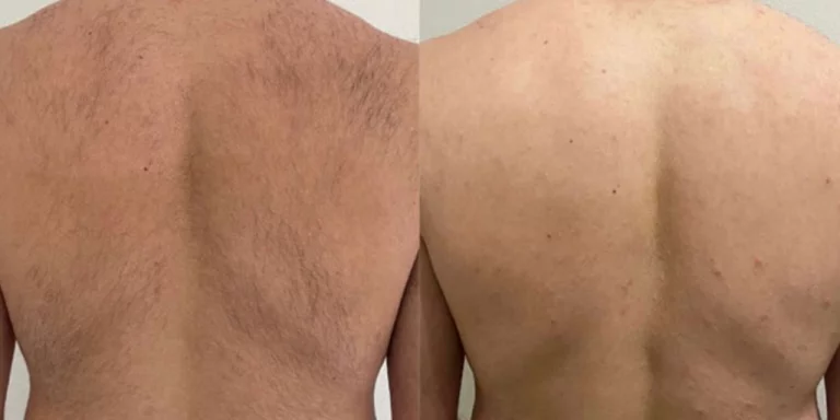 laser-hair-removal-berlin-before-after