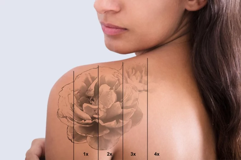 Tattooentfernung Berlin