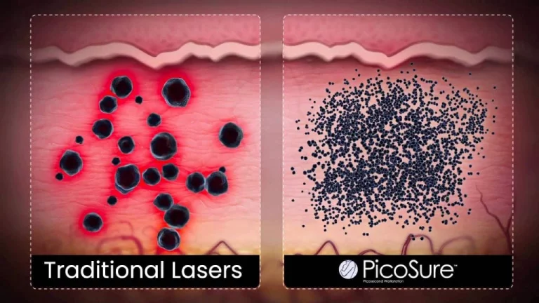 Nanosekundenlaser vs. PicoSure bei Zertrümmerung der Tattoo-Partikel BellaDrerma Berlin