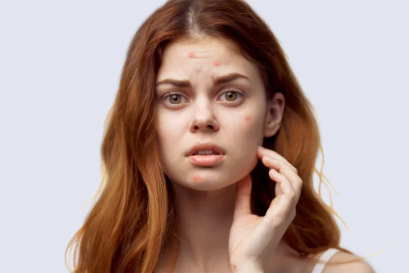 Acne treatment Berlin