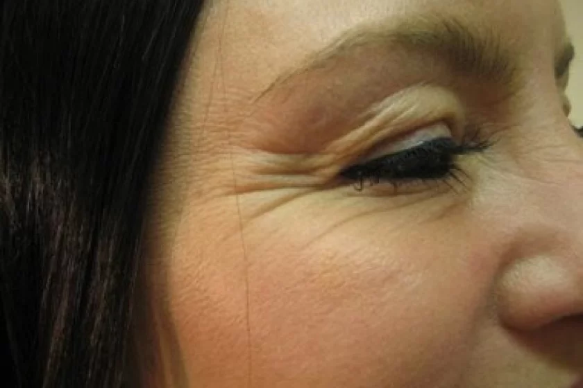 Augenfalten entfernen Berlin