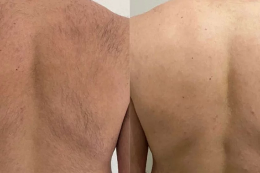 dauerhafte Haarentfernung  Rücken Berlin