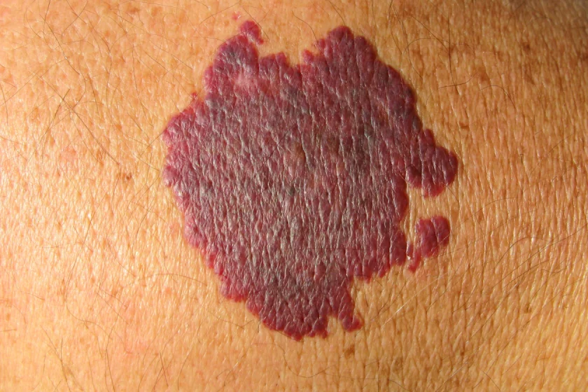 Feuermal entfernen in Berlin