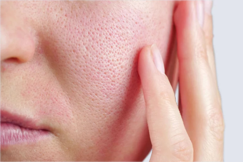 reducing large pores Berlin