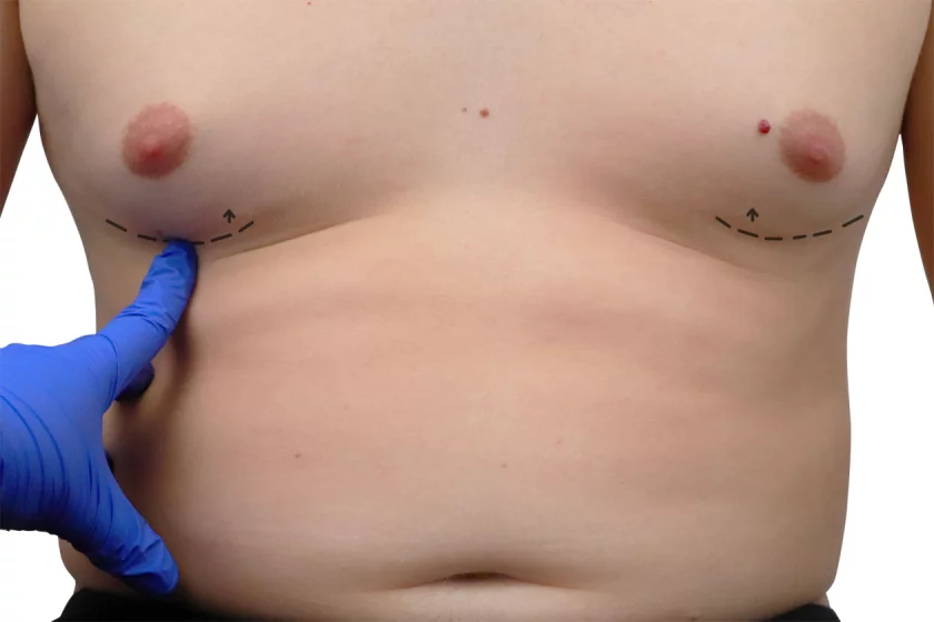 male breast treatment Berlin