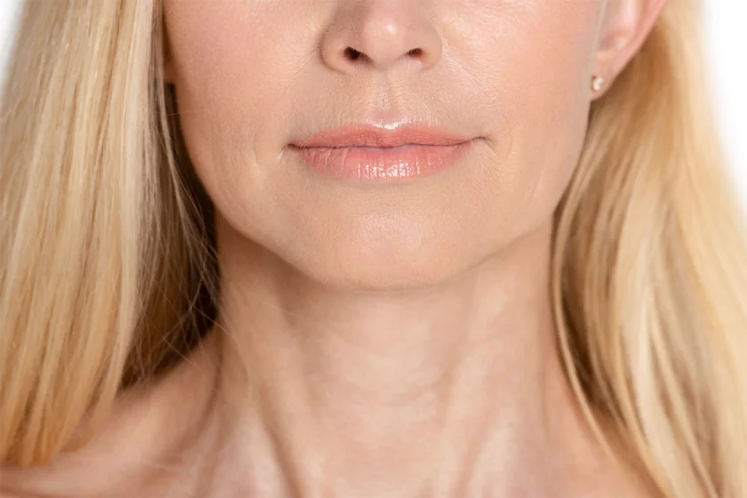 Marionettenfalten unterspritzen Berlin