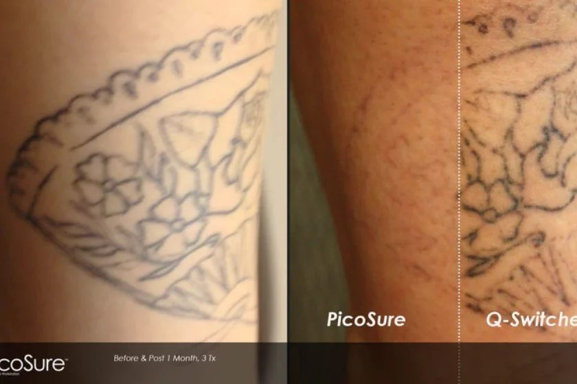 PicoSure versus Q-switched bei BellaDerma in Berlin
