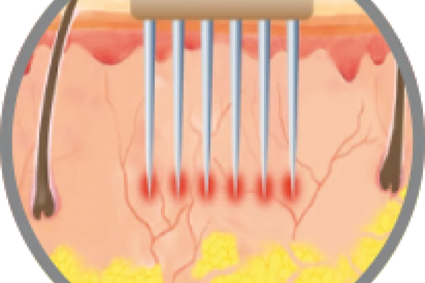RF-Microneedling Berlin